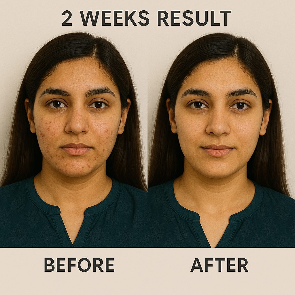 Aennys Acne Bundle – Serum + Facewash for Fast & Clear Results